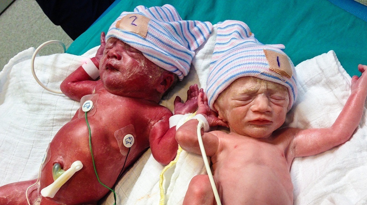 What is TTTS – Twin to Twin Transfusion Syndrome ? » TwinStuff