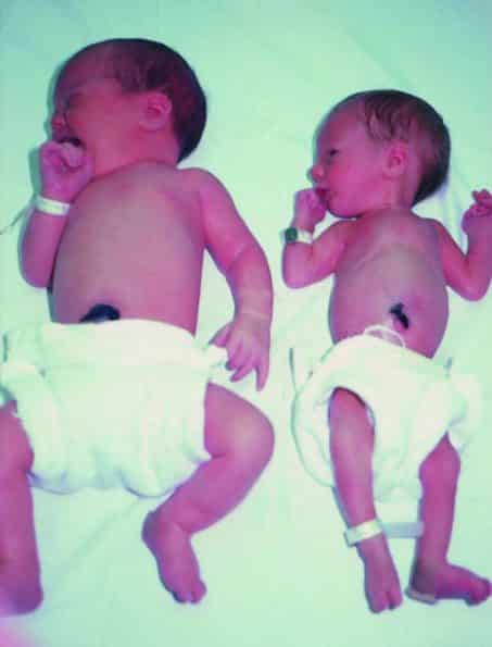 Discordant Twins What Causes Twin Growth Discordance TwinStuff