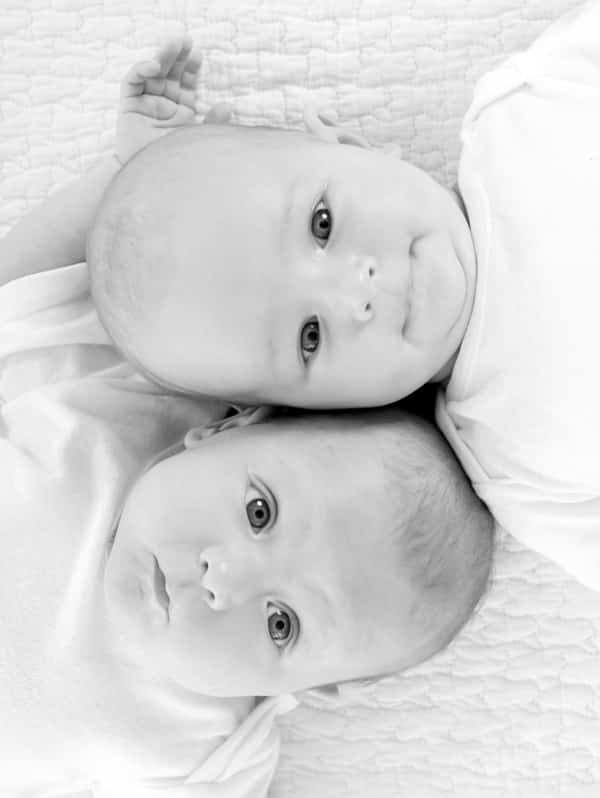 what is a parasitic twin